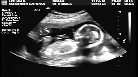 18 hafta gebelik ultrason görüntüleri